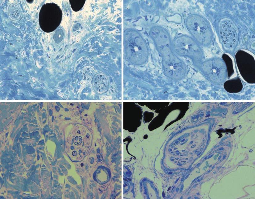 A B C D Figure 8. Light-microscopic findings of epon-embedded skin tissues stained with 1% toluidine blue. A, B: Findings for the first toe skin in patient No. 18, who was diagnosed with CRPS-I.