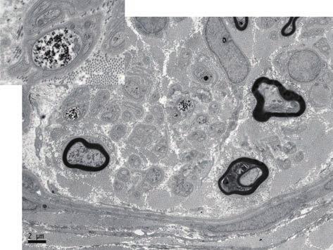 A B 10 A B * 2 Figure 9. Electron-microscopic findings of the intradermal nerves in the second finger in Case 2.