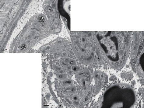 Electron-microscopic findings of the intradermal nerves in the first toe of in Case 2.