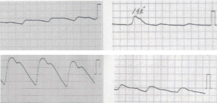 A B Figure 2. Impaired writing of letters in Case 2. A: On admission, the patient s writing was poor due to hand tremulousness. The irregular lines are noteworthy.