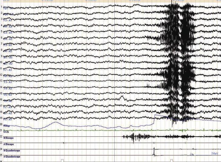Repetitive bursts appear at irregular intervals and the muscle contractions are not synchronous with each other, indicating that the involuntary movement is a myoclonic jerk. EEG lt. Bi rt. Bi lt.