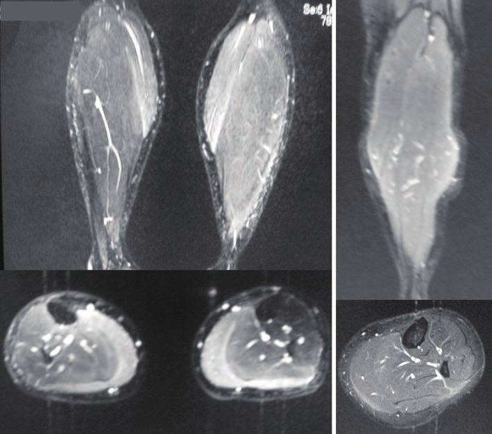 A B Figure 7. MRI findings of the calf muscles in Case 4. A: On admission, both gastrocnemius muscles showed high-signal lesions on flair-weighted images with gadolinium enhancement.