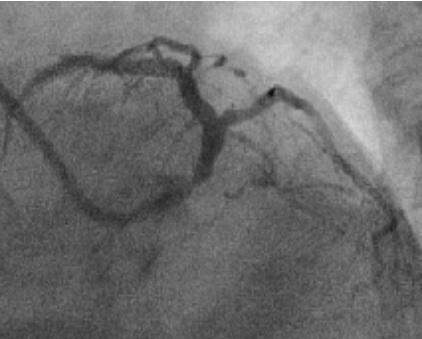 Siddiqui et al. 6 Figure 1: Diagnostic angiogram LAO caudal view showing plaquing in left main coronary artery with significant disease in mid left anterior descending coronary artery (Case 1).