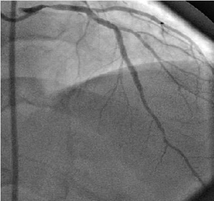 His diagnostic coronary angiogram showed 30 40% lesion in proximal left main stem, critical disease in mid LAD and diagonal branch (bifurcation lesion), moderate disease in mid right coronary artery