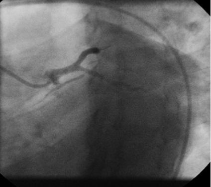 Siddiqui et al. 7 Figure 4: Diagnostic angiogram LAO caudal view showing plaquing in left main coronary artery with significant disease in LAD (Case 2).