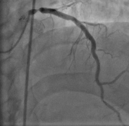 He underwent coronary angiogram which showed critical lesion in distal left main, in stent restenosis with total occlusion in LCX stent and patent RCA stent (Figure 5 and Figure 6).