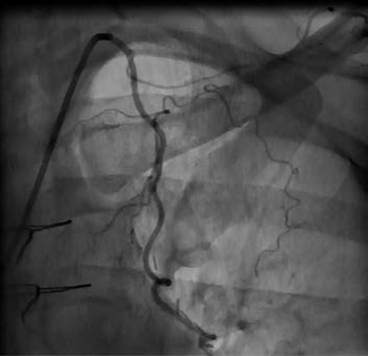 ASEAN Heart Journal Vol. 22, no.1, 116-121 (2014) kinking of the LIMA during surgical mobilization 2 or occasionally a surgical clip, 3 both of which may be treated by angioplasty.