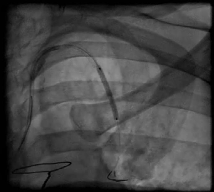 4 Figure Figure 4 Angiogram of LIMA.