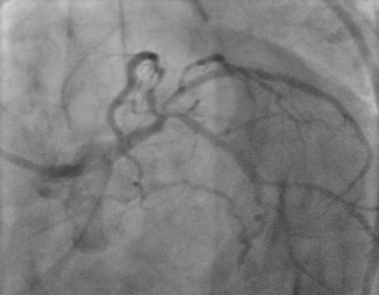 Ramus intermedius was predilated with 2.5 15 mm non-compliant (NC) at 14 atm. The LMS-LAD was stented with Resolute Integrity stent (Zatrolilimus-Eluting, Medtronic, Minneapolis, USA) 4.