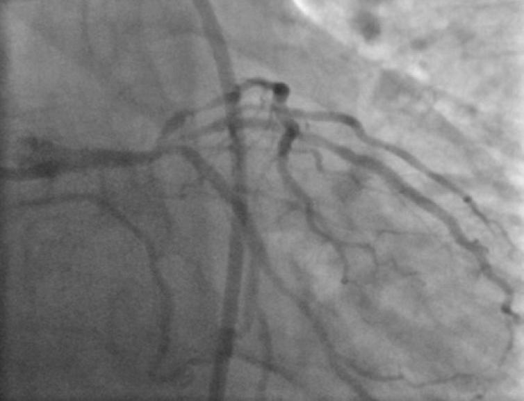 5 26 mm at 14 atm implanted distally with 1 mm overlap with proximal stent, ballooning done in-between two stents at 16 atm (Figure 3 and Figure 4).