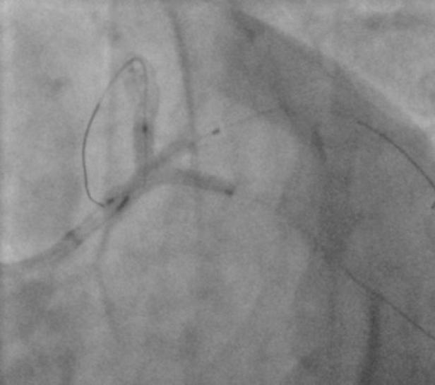 It shows LMS & proximal LAD after stenting.