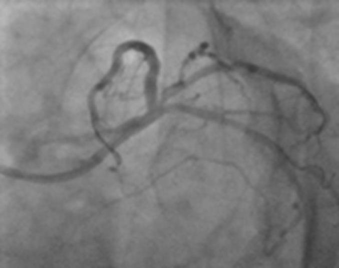 Figure 6. It shows dissection of ostial ramus intermedius after ballooning. Figure 7. IVUS showing the ostial ramus intermedius.