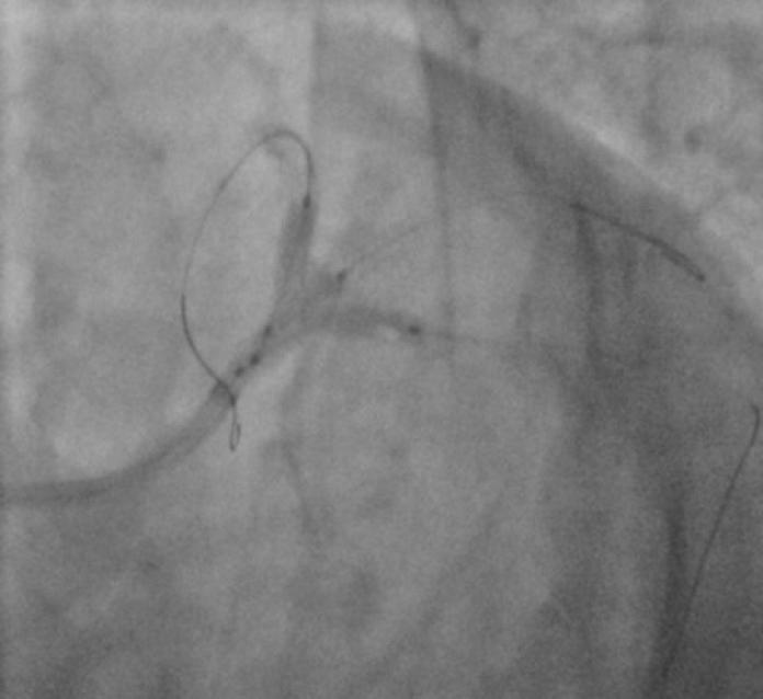 2 stent implantation in the ostial LtCx &