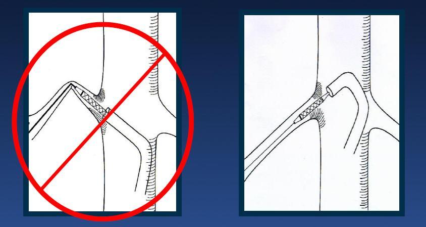 Guidewires Avoid hydrophilic wires and mind wire tip