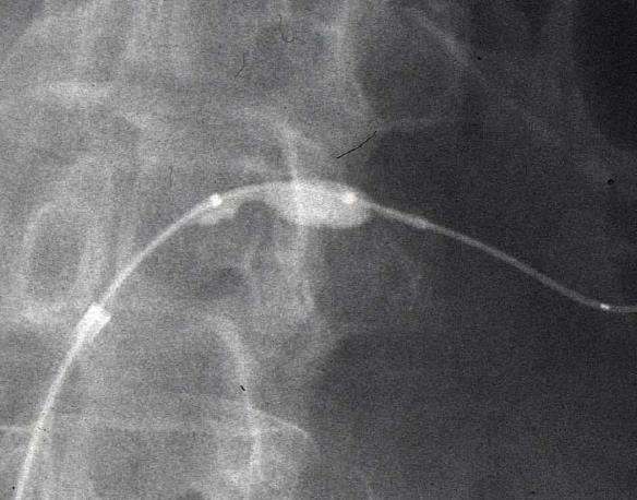 Pre-dilation Outline lesion before stenting Verify vessel diameter Ease stent delivery Avoid