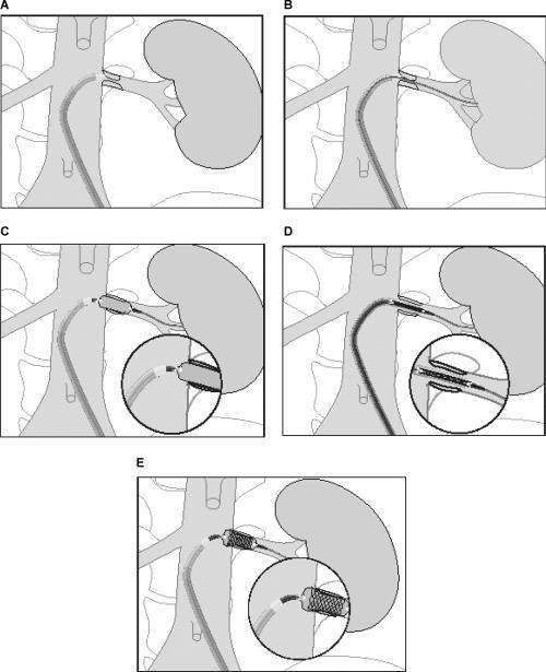 Renal Artery Stent Placement: Avoid Geographic Miss ( Stick the Landing ) 2 mm into aorta