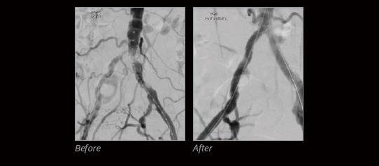 VBX Stent Graft Performance GORE, VIABAHN, and designs are