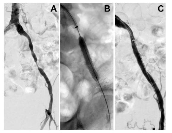 Flexible Strength Case Study (Holden 1 ) The Challenge (A) High-grade focal left external iliac artery stenosis The Procedure (B) VBX is deployed across the aortic bifurcation from the right common