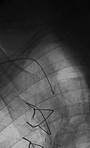 Procedure RCA 6F right radial Next day Retrograde RIMA>RCA reopening of RCA CTO and