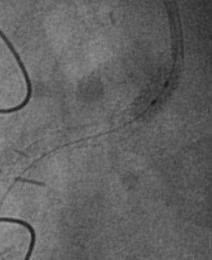 GC Engagement of RCA Anterograde Stenting RCA