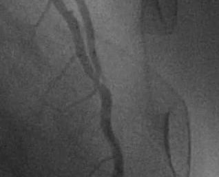 RCA Ostial instent occlusion LIMA-LAD Distal anastomosis