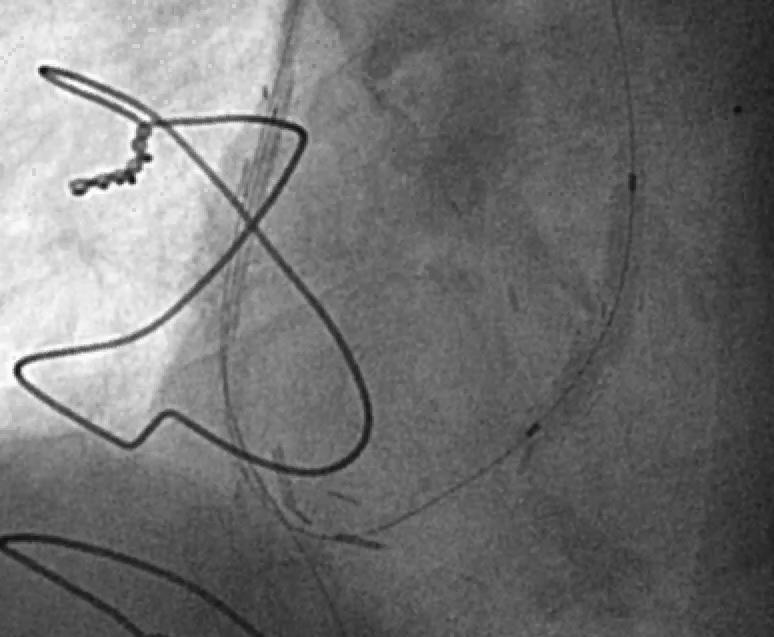 Anterograde Stenting RCA Post-dilatation IVUS and FFR Fig.8.a. Filder XT and OTW Fig.