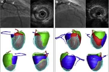 FUTURE DIRECTIONS CT Angiography-based myocardial segmentation (CAMS) CAMS Sensitivity 85% Specificity 92% PPV