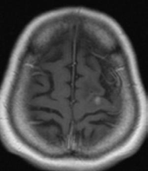 brain met Craniotomy and GTR 5/1/12
