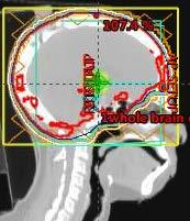 Background Stereotactic Radiosurgery (SRS)
