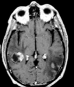 most common intracranial tumour survival for