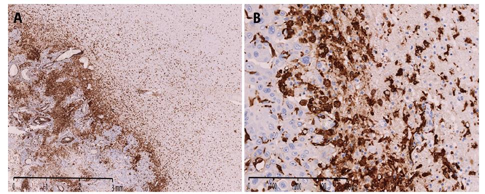 Microglia/macrophages in brain metastases