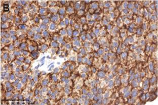 PD-L1 expression in brain metastases