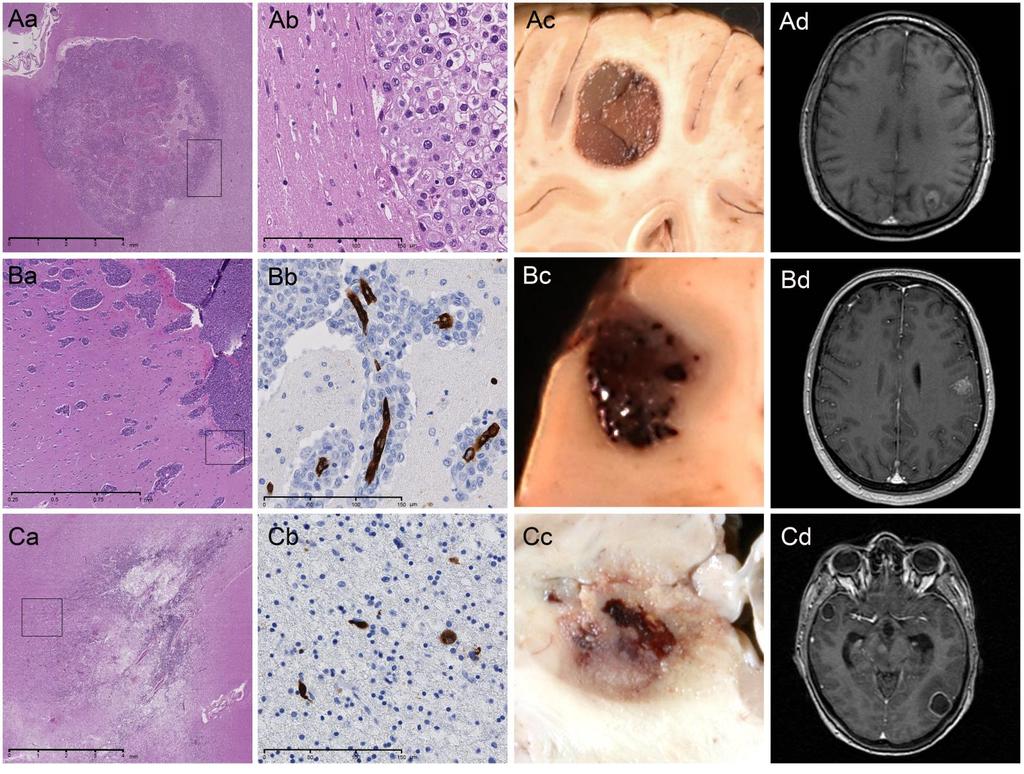 Growth patterns of brain metastases Delineated 51%