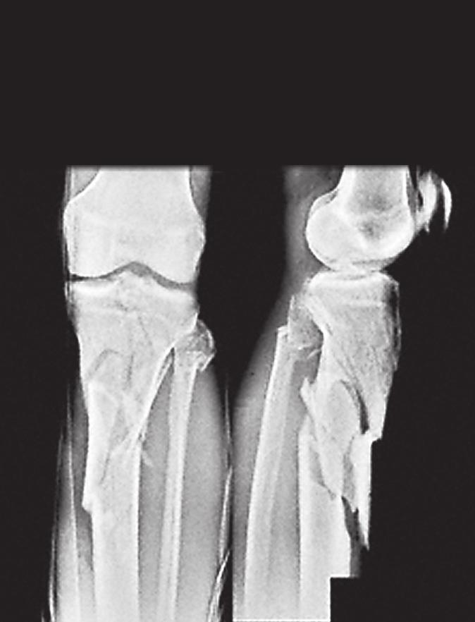 2.2 Diaphyseal fractures: principles Fig 2.2-2a d High-velocity injury (motor vehicle accident) to the proximal half of the tibia in a 30-year-old man.