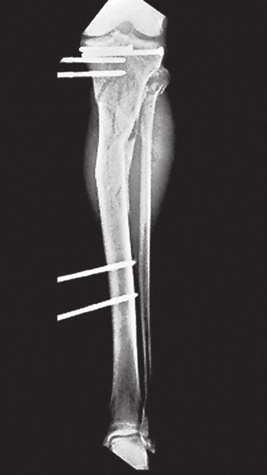The complex fracture pattern suggests extensive soft-tissue damage despite the fact that the fracture is closed.