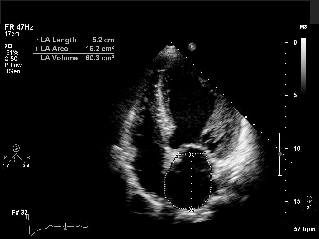 3. ATRIA: Atria are considered as the window to the ventricles. For example the first sign of significant LV diastolic dysfunction is an enlarged left atrium.