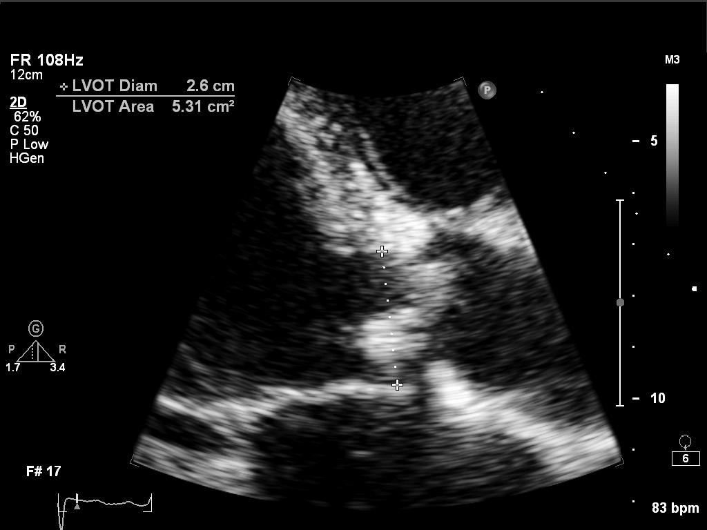 Aortic Valve (AV) - Significant aortic stenosis is usually diagnosed by the appearance of calcified and restricted leaflets on Para-sternal long axis (PLAX) and Parasternal Short Axis (PSAX) views