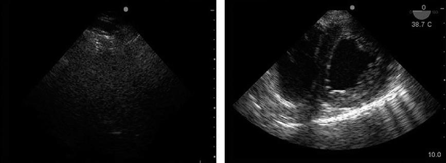 signs of tamponade are a direct consequence of increased pericardial pressure, leading to diastolic collapse of one or more cardiac chambers (usually on the right side first).