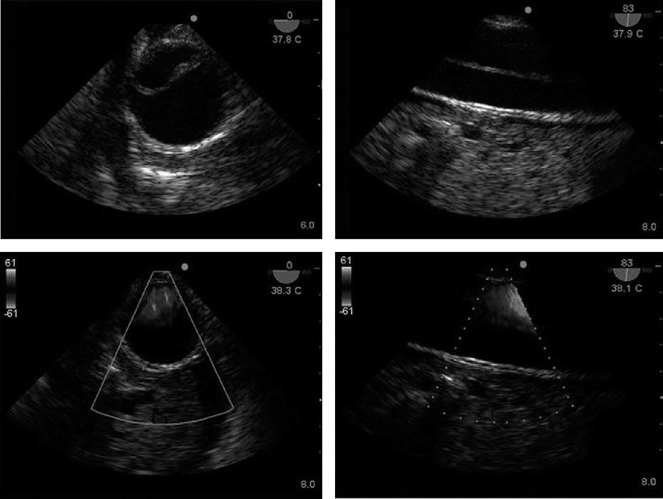 TEE has also been clearly shown to be superior to TTE for diagnosing complications of endocarditis, such as aortic root abscess, fistulas, and ruptured chordae tendineae of the mitral valve (93).