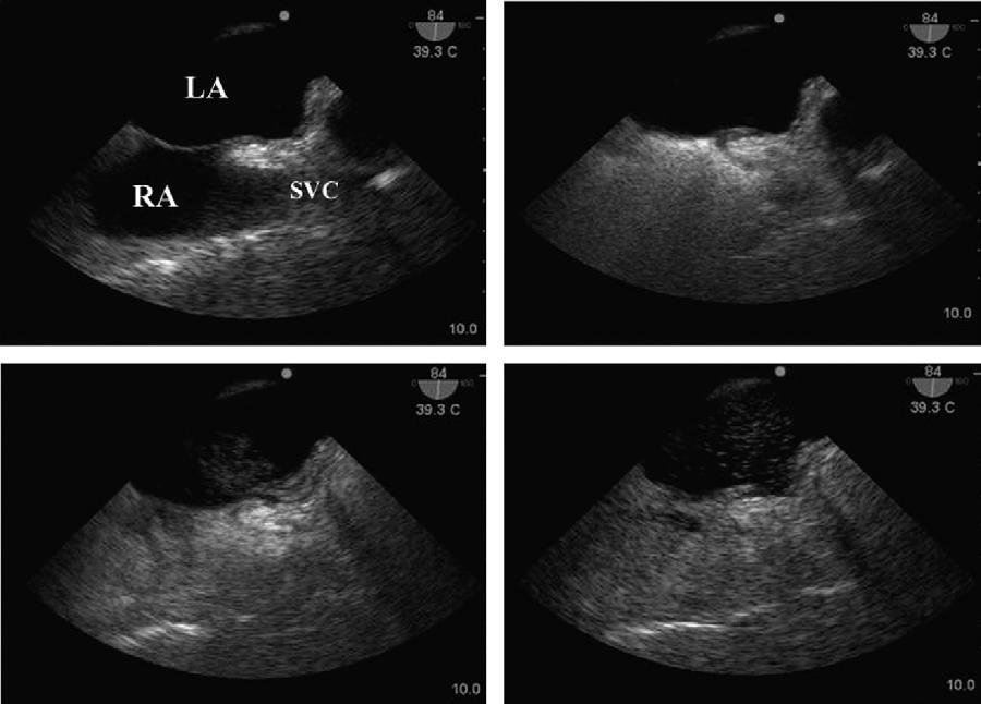 men ovale, atrial septal defect, and pulmonary arteriovenous fistula (115) due to the close proximity of the lesion to the ultrasound transducer. SOURCE OF EMBOLUS Figure 5.