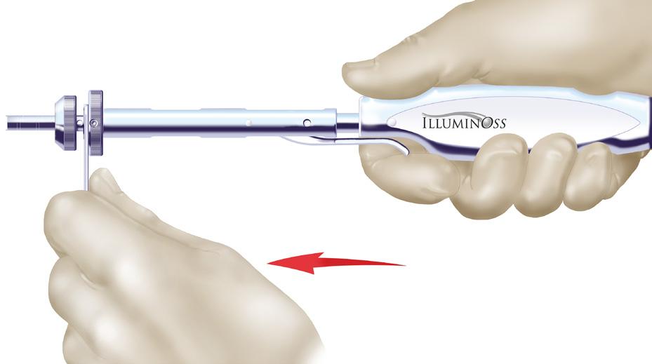 Slide the jaw tips over the catheter protruding from the stabilizer.
