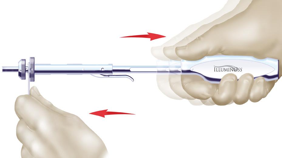 18). Removal Of Catheter From Implant Hold the stabilizer handle with one hand and apply forward pressure against the proximal end of the balloon.