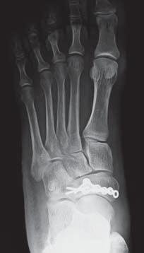 X-ray Case 3 Navicular