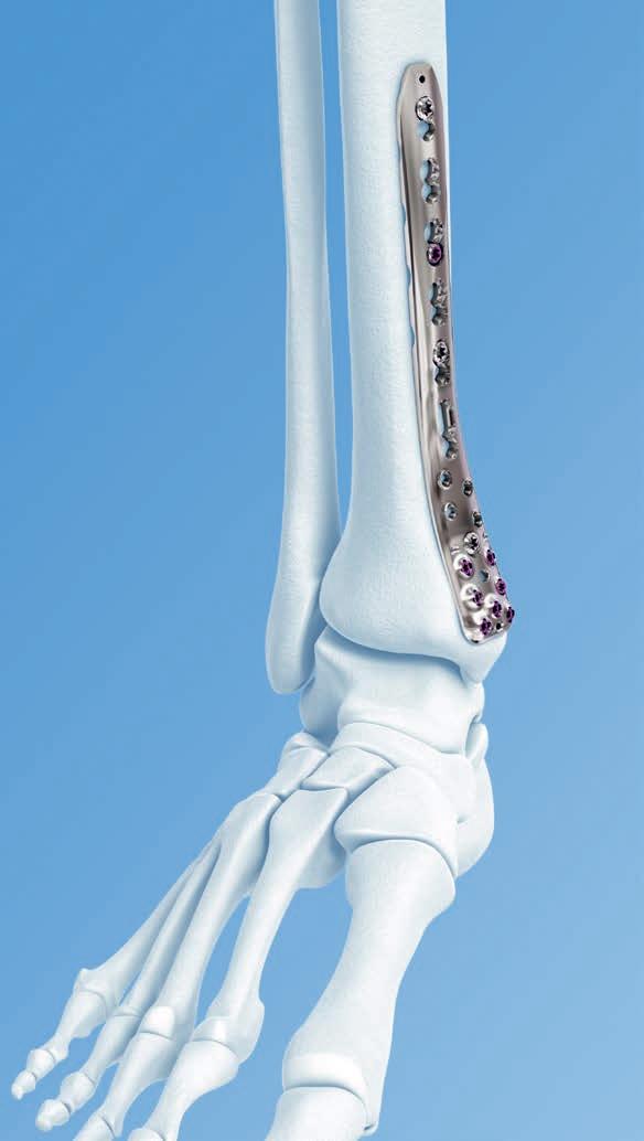 VA-LCP Ankle Trauma System 2.7/3.5.