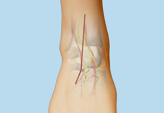 Anterolateral plate A longitudinal and straight incision should be centered at the ankle joint, parallel to the fourth metatarsal distally, and between the tibia and fibula proximally.