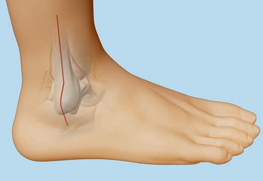 The joint can be exposed using an arthrotomy. Fibula plate Make a straight lateral or posterolateral surgical incision to expose the fibular fracture, the distal fibula, and the fibular diaphysis.
