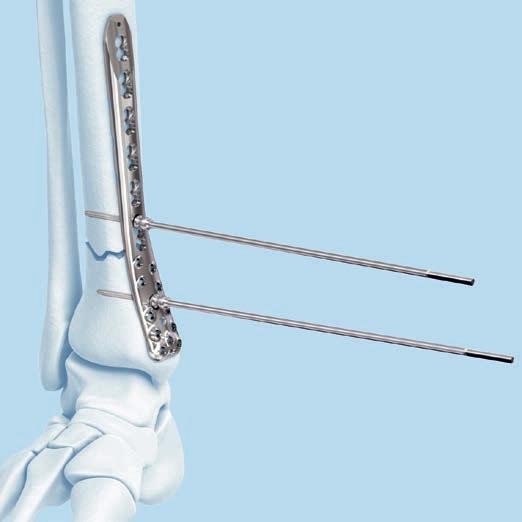 Use of Compression/Distraction System 2 Place second fixation point A second fixation point is required to span the fracture, which can be achieved using one of the following techniques: Option A: