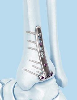 fibula, especially in osteopenic bone. VA-LCP Posterolateral L- and T-Plates 2.