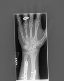 Most Common Missed Fracture?