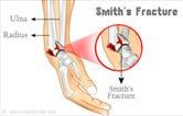 Smith s Fracture